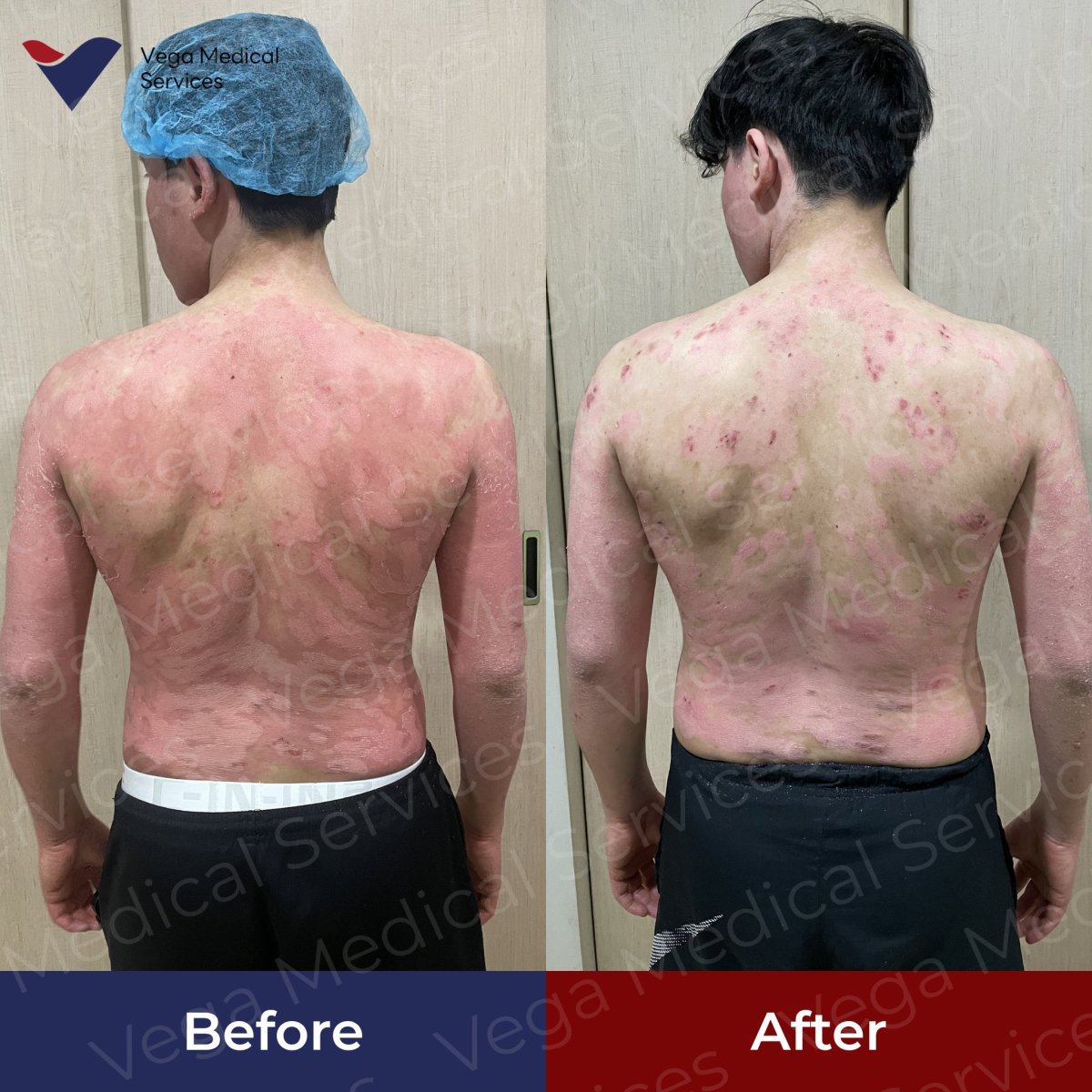 Before and after stem cell therapy for skin condition at Vega Clinic, visible improvement result
