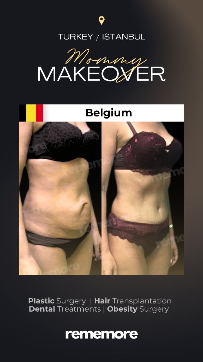 Before and after mommy makeover results at Memorial Şişli Hospital, body contour improvement