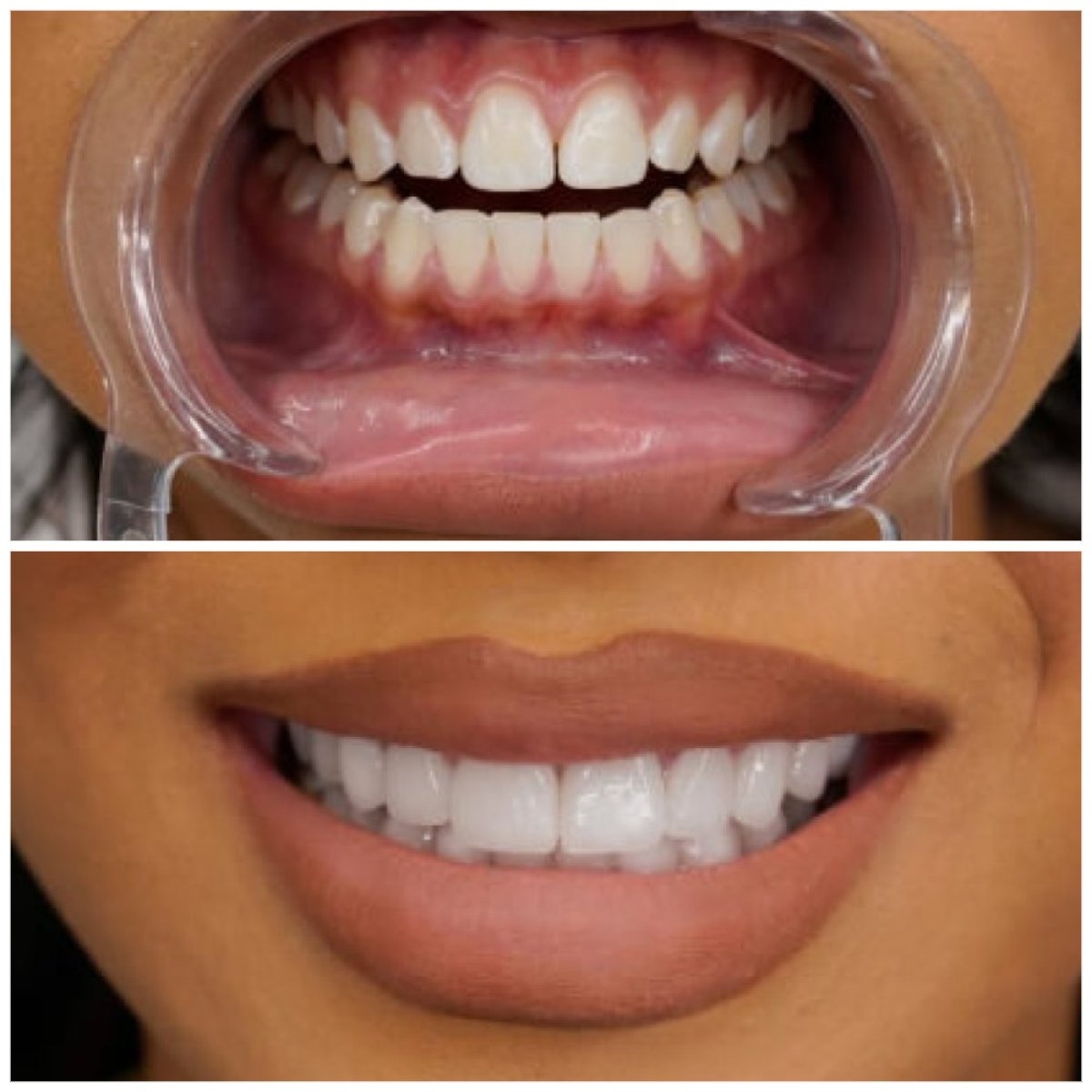 До и после установки виниров Emax в Türkiye Dental, естественно белая улыбка