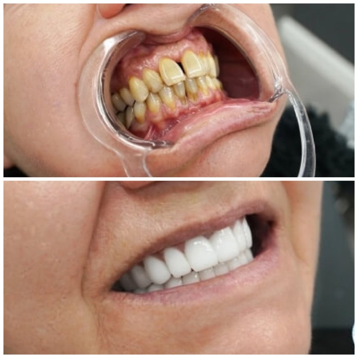 Результаты до и после улыбки в Türkiye Dental: белее и ровнее зубы после процедуры