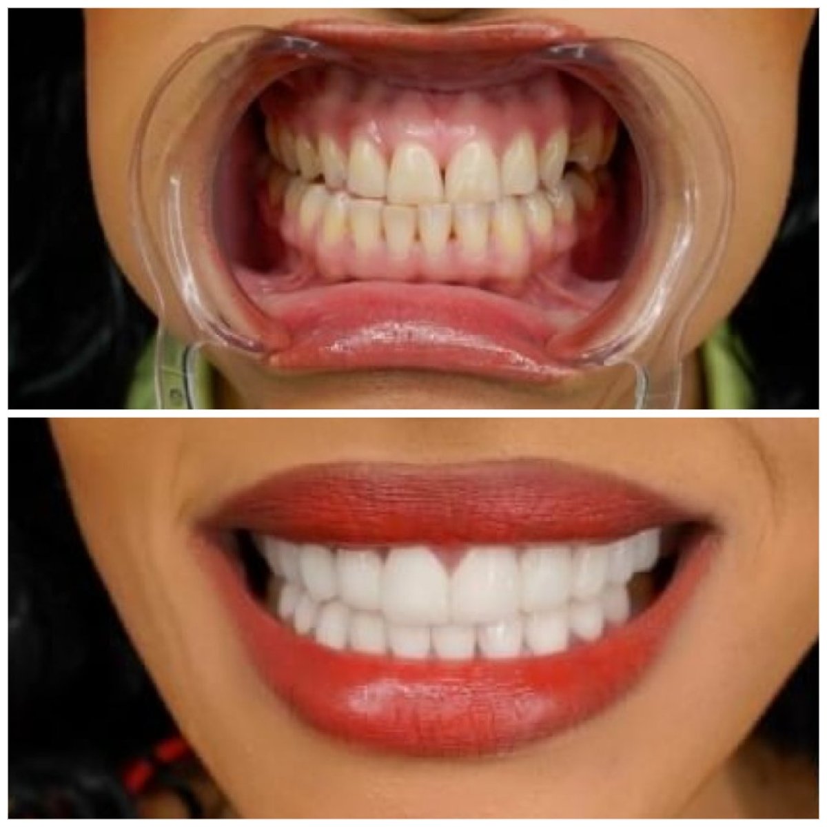 Результаты отбеливания зубов до и после в Türkiye Dental – заметно белее улыбка