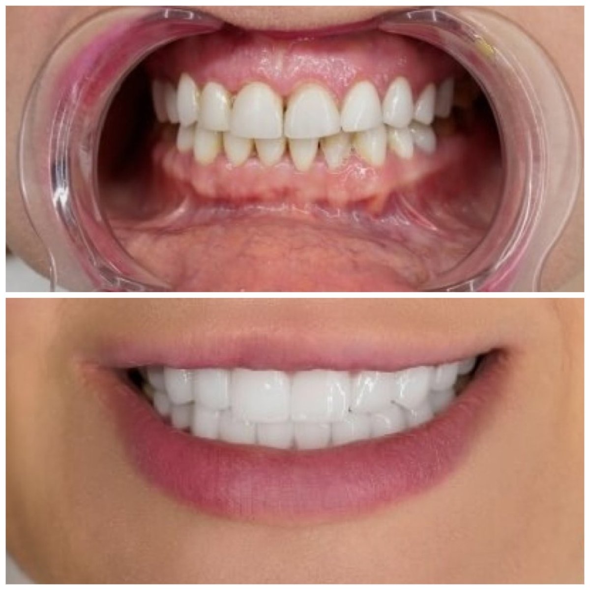 Результаты до и после отбеливания зубов в Türkiye Dental, заметно более белая улыбка
