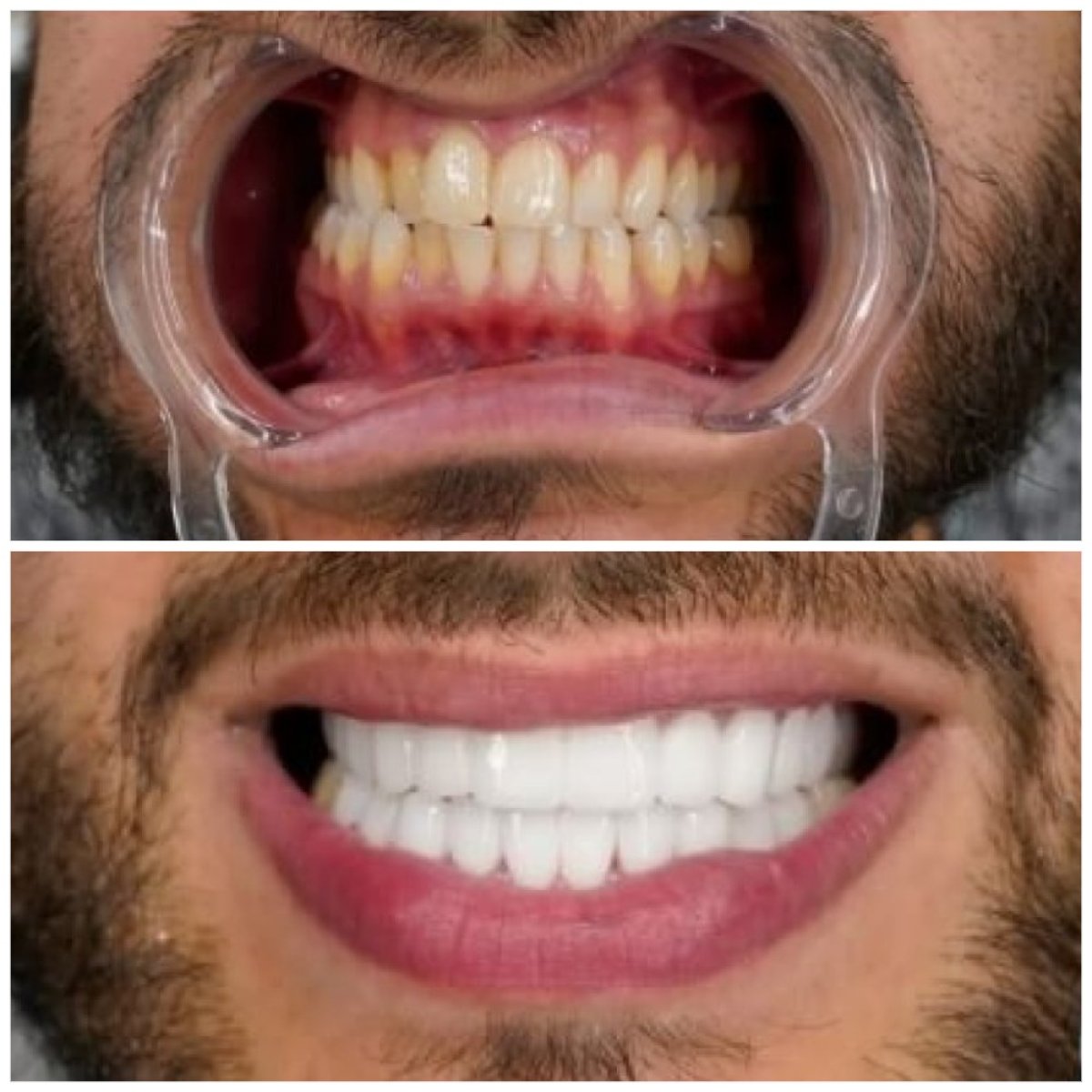 نتائج تبييض الأسنان قبل وبعد في Türkiye Dental – ابتسامة أكثر بياضاً وإشراقاً
