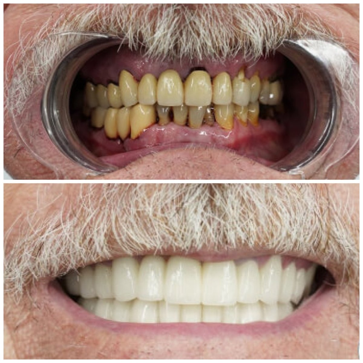 Результаты до и после установки циркониевых коронок в Türkiye Dental – восстановление улыбки