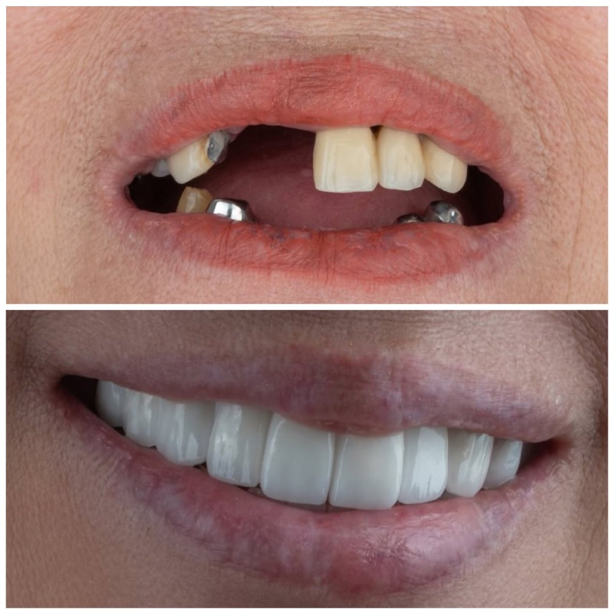 Résultat avant/après implants All-on-6 chez Türkiye Dental – restauration complète du sourire