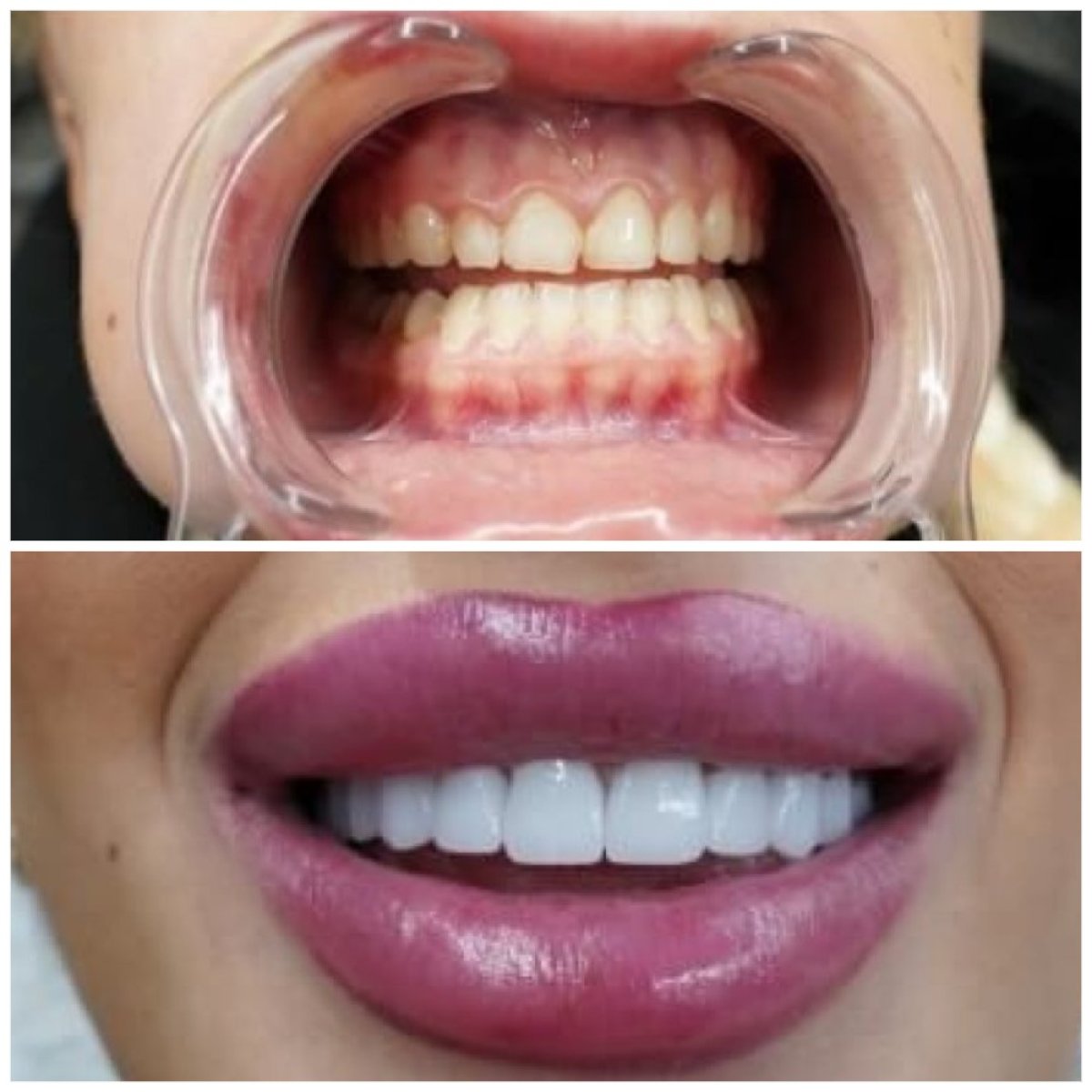 نتائج قبل وبعد عدسات الأسنان في Türkiye Dental، ابتسامة طبيعية وجذابة