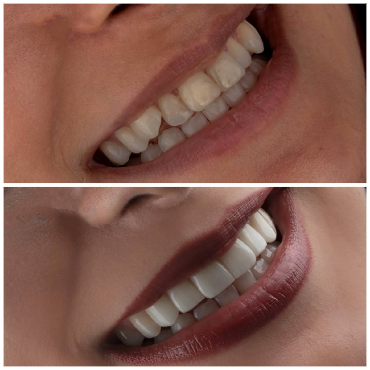 Antes y después de carillas dentales en Türkiye Dental: sonrisa más blanca y uniforme