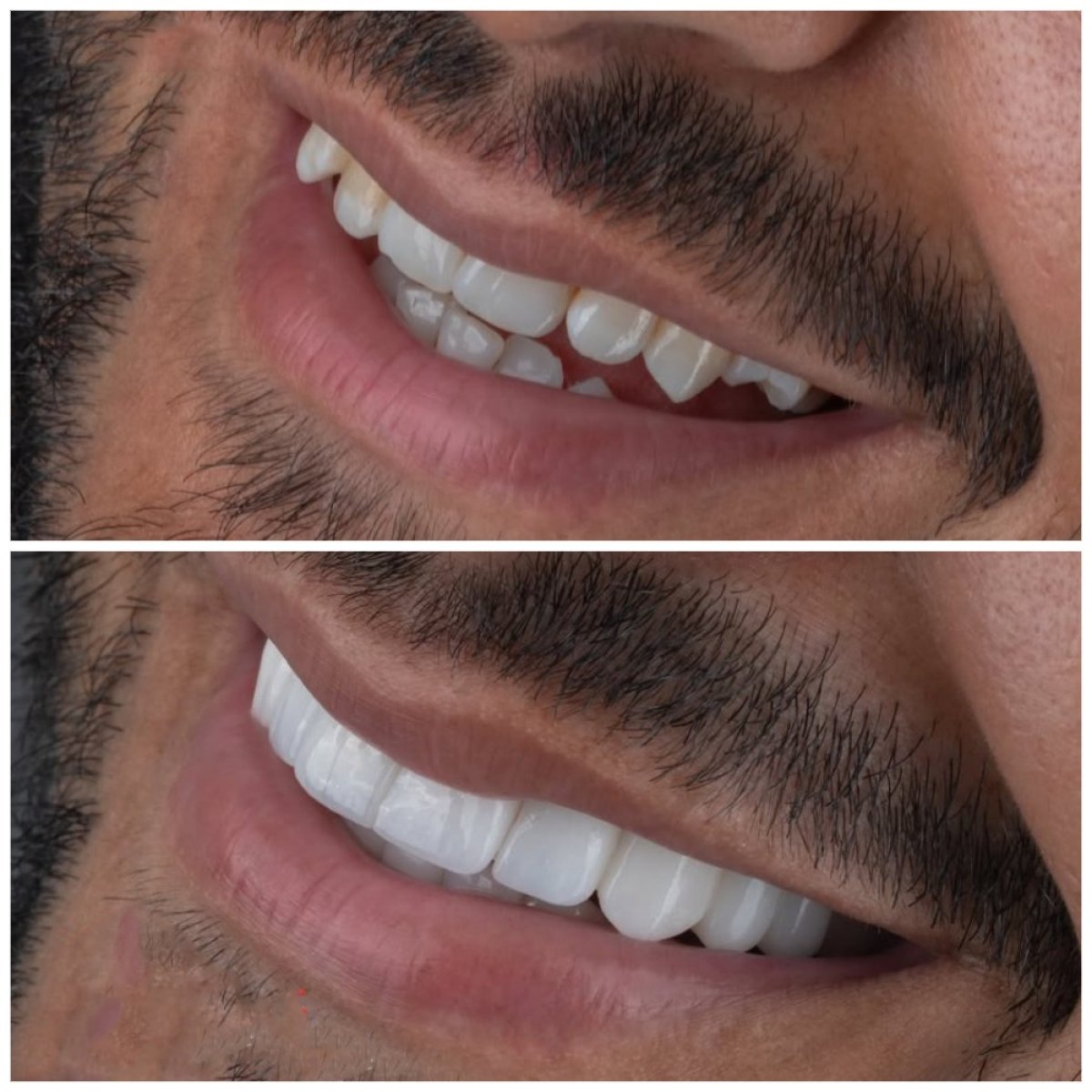 قبل وبعد الفينير في Türkiye Dental، ابتسامة أكثر بياضاً وتناسقاً