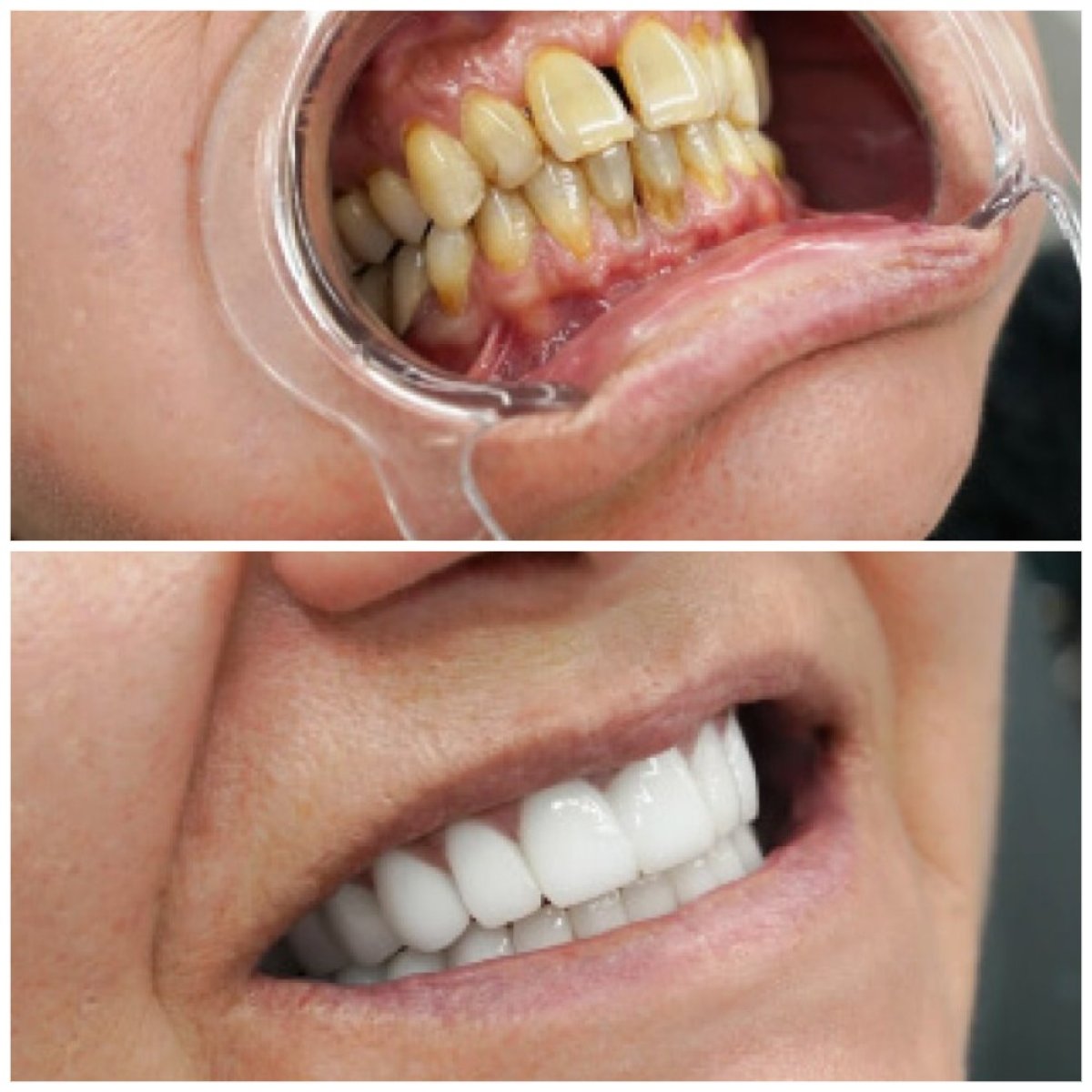 Antes y después de la colocación de coronas dentales en Türkiye Dental, resultados de sonrisa