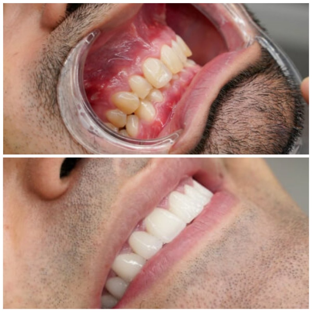 قبل وبعد تركيب تيجان الأسنان في Türkiye Dental، تحسين الابتسامة ومحاذاة الأسنان