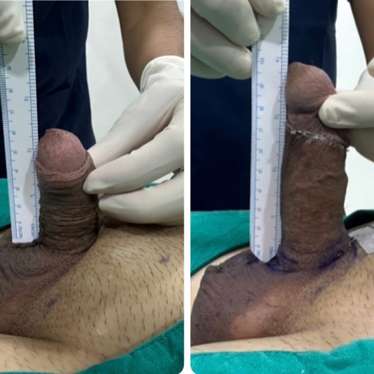 Before and after penis filler results at Eternity Clinic Phuket By Dr.Beer, visible length increase