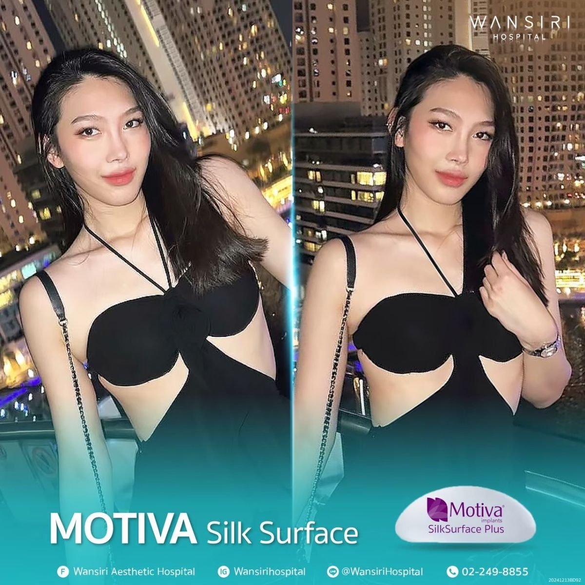 Before and after breast augmentation with Motiva implants at Wansiri Hospital, visible results