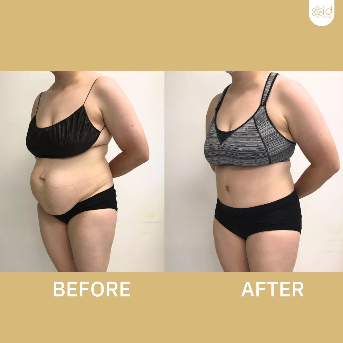 Before and after tummy tuck and liposuction results at ID Clinic Bangkok, improved body contour