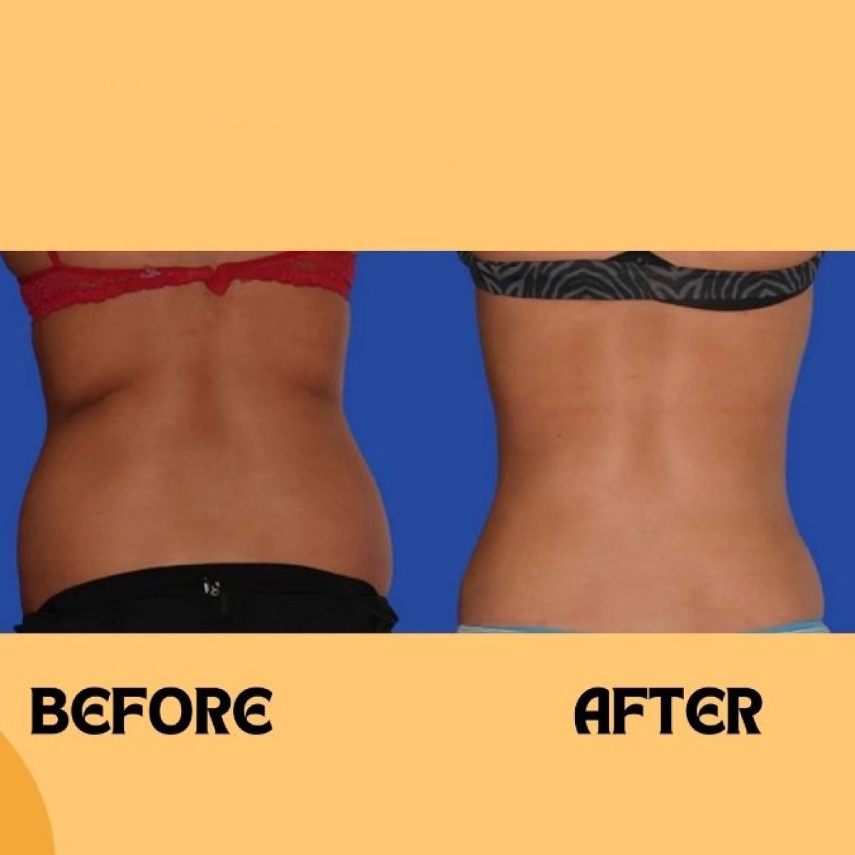 Resultados de liposucción antes y después en ID Clinic Bangkok con cintura más delgada