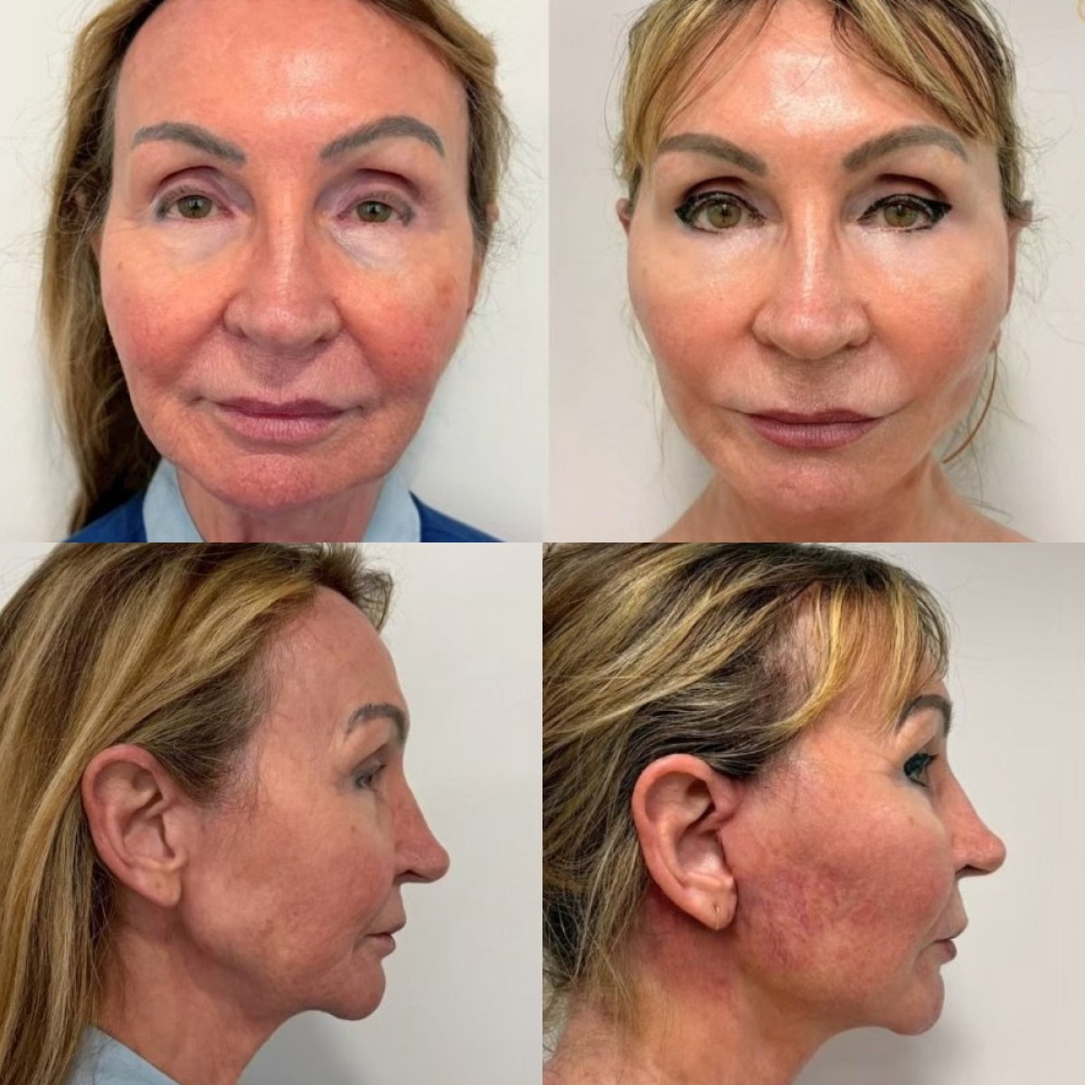 Before and after deep plane facelift results at ID Clinic Bangkok, visible facial rejuvenation