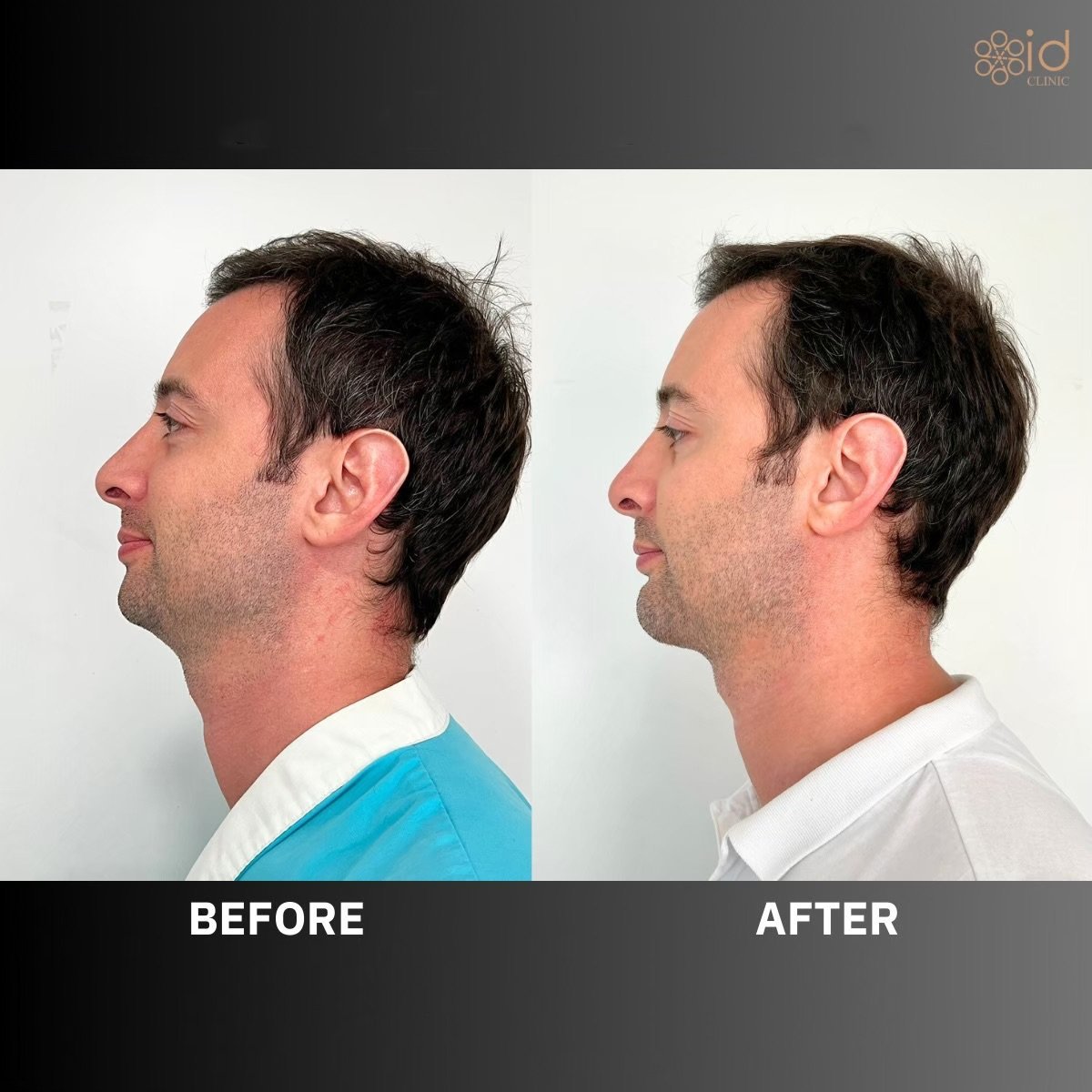 Before and after chin implant results at ID Clinic Bangkok, improved chin contour in male patient
