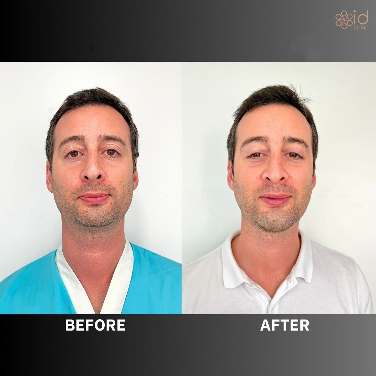 Before and after chin implant results at ID Clinic Bangkok, enhanced chin contour visible