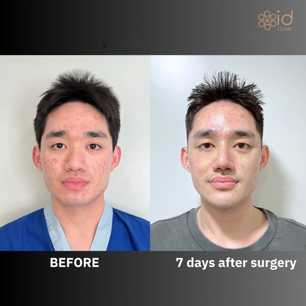 Chin implant before and after results at ID Clinic Bangkok, visible chin enhancement after 7 days