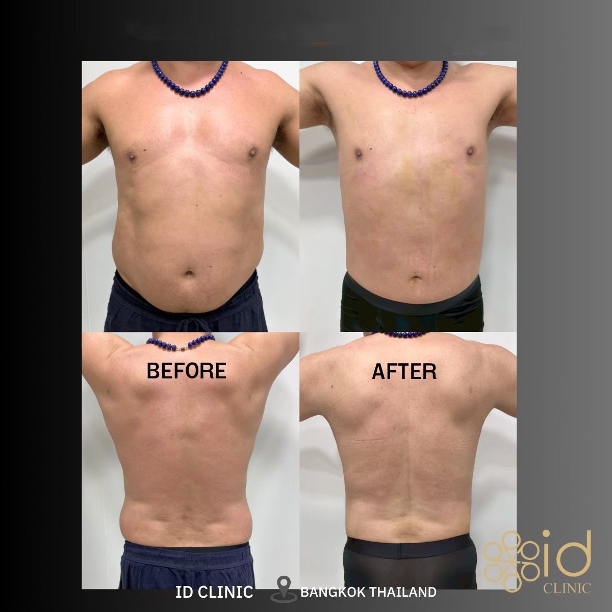 Before and after Vaser liposuction results at ID Clinic Bangkok, improved body contour in male