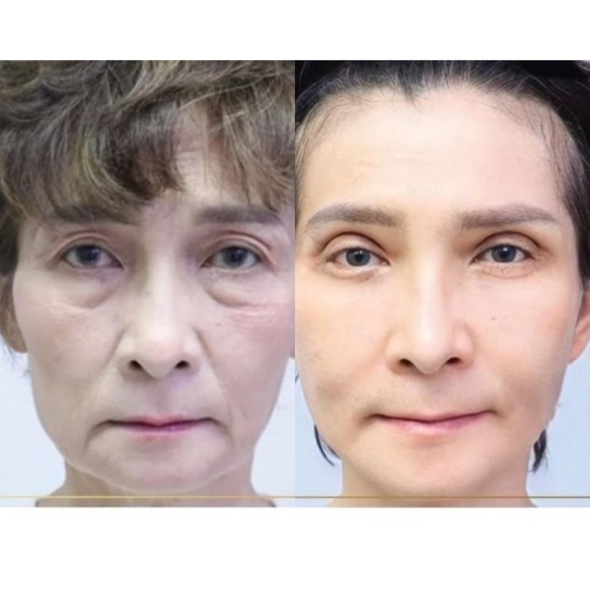Before and after deep plane facelift results at Asia Cosmetic Hospital, facial rejuvenation