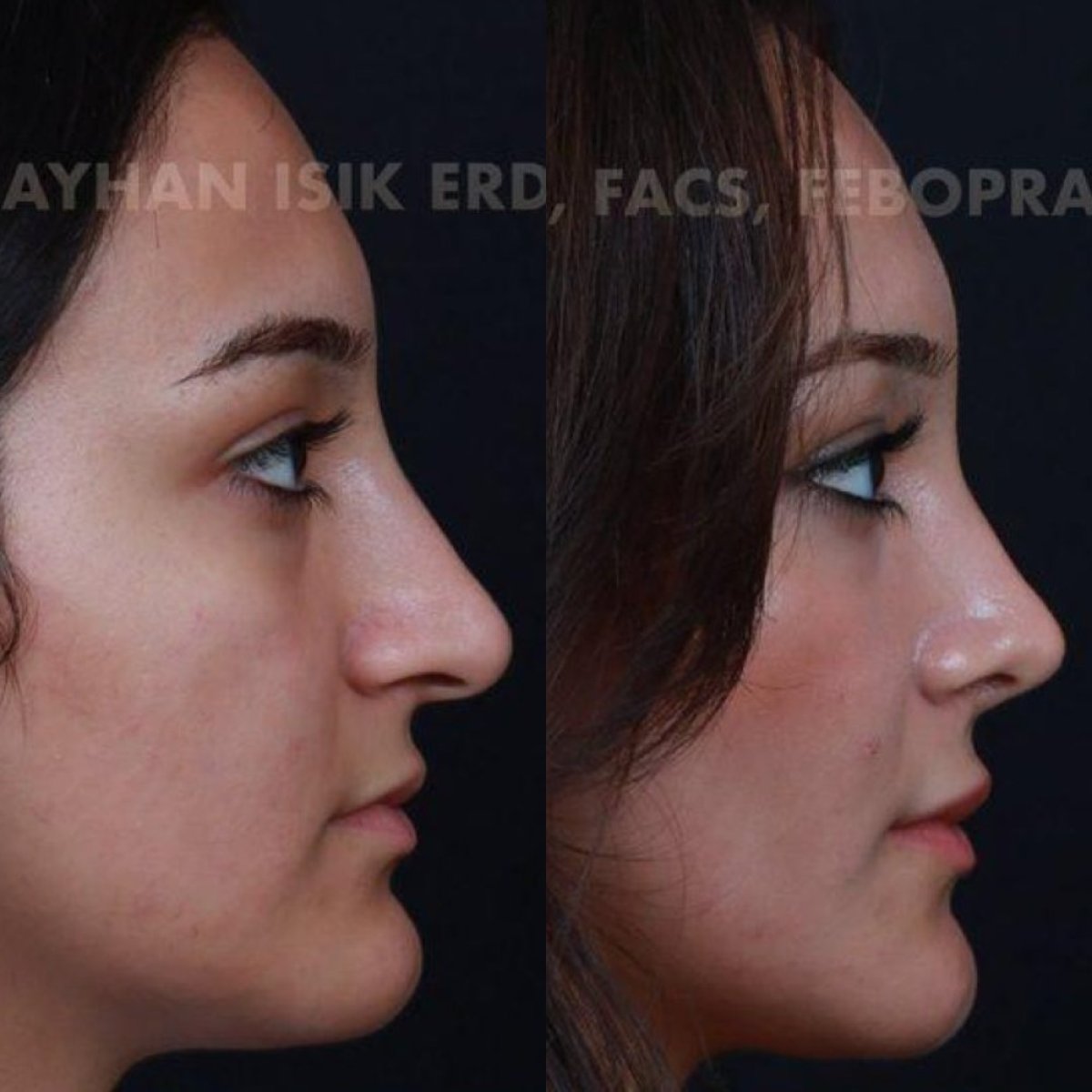 نتائج عملية تجميل الأنف قبل وبعد في عيادة Ayhan Işık Erdal, MD, FACS, FEBOPRAS
