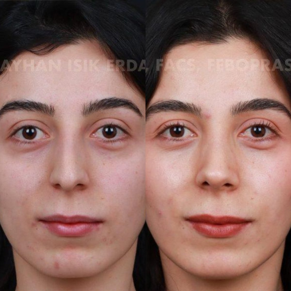 Before and after rhinoplasty results at Ayhan Işık Erdal, MD, FACS, FEBOPRAS, nose reshaping