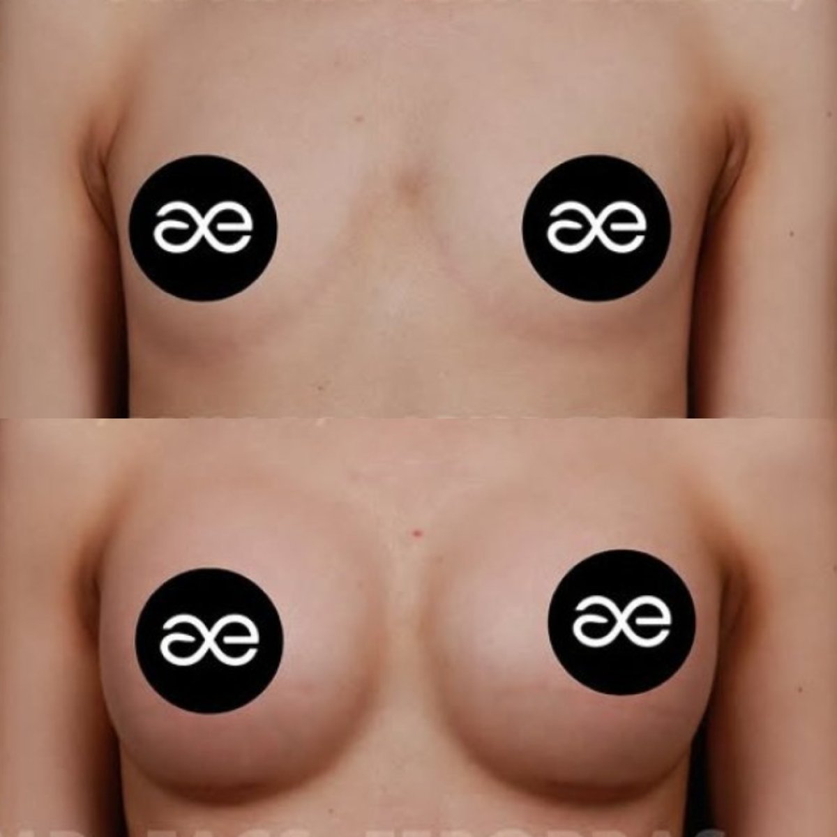 Before and after breast augmentation results at Ayhan Işık Erdal, MD, FACS, FEBOPRAS clinic