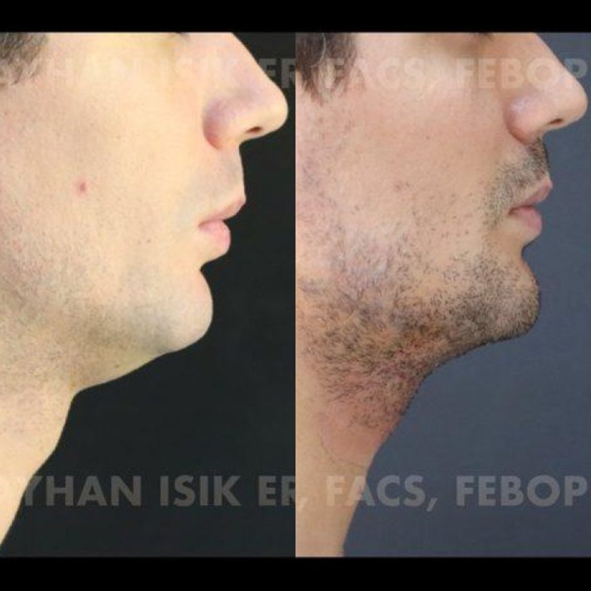 Результаты до и после липосакции подбородка в клинике Ayhan Işık Erdal, MD, FACS, FEBOPRAS