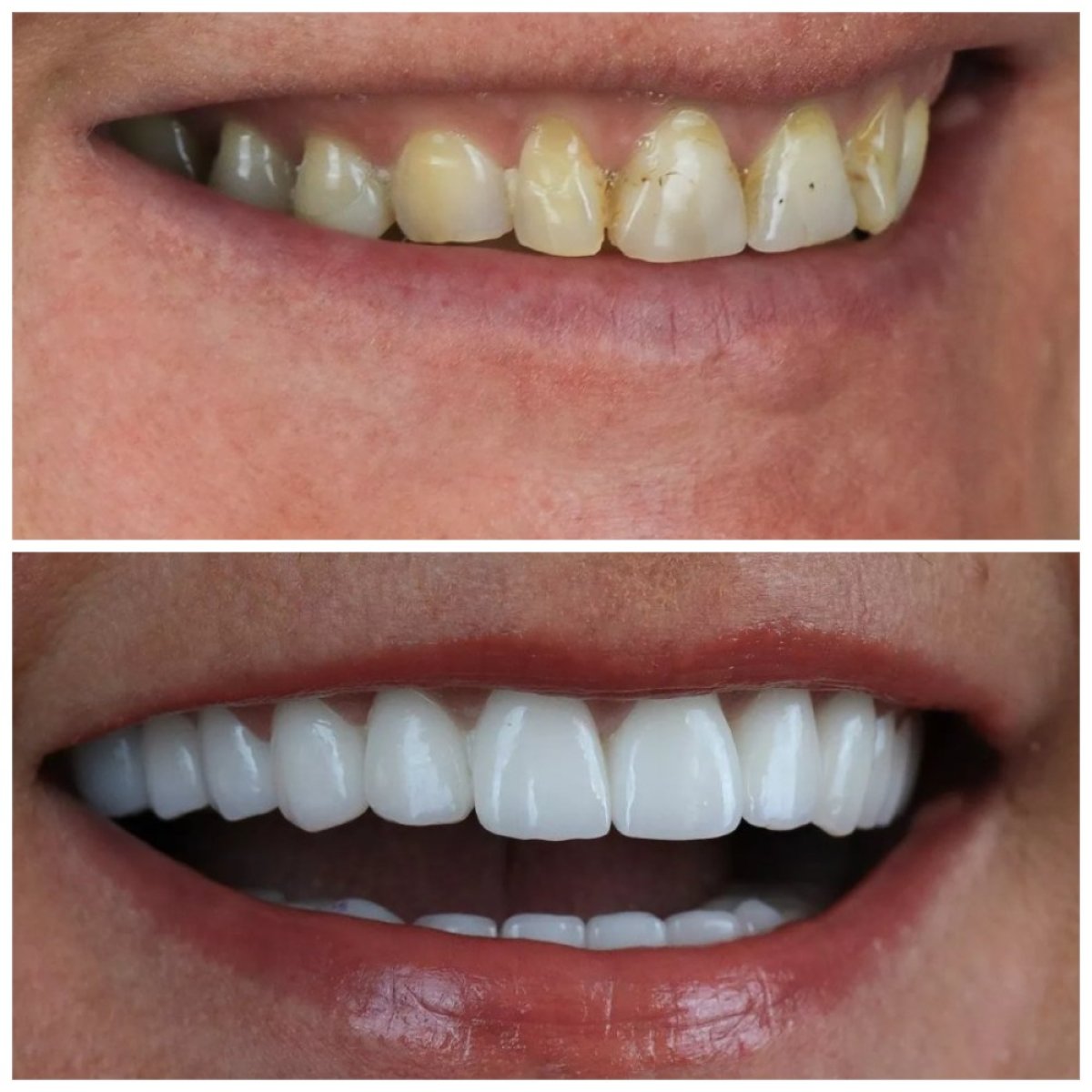 Результаты до и после Hollywood Smile в Dentaverse Turkey – преображение винирами