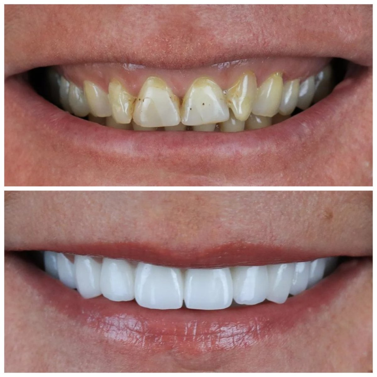 До и после виниров Hollywood Smile в Dentaverse Turkey, видимый результат преображения улыбки