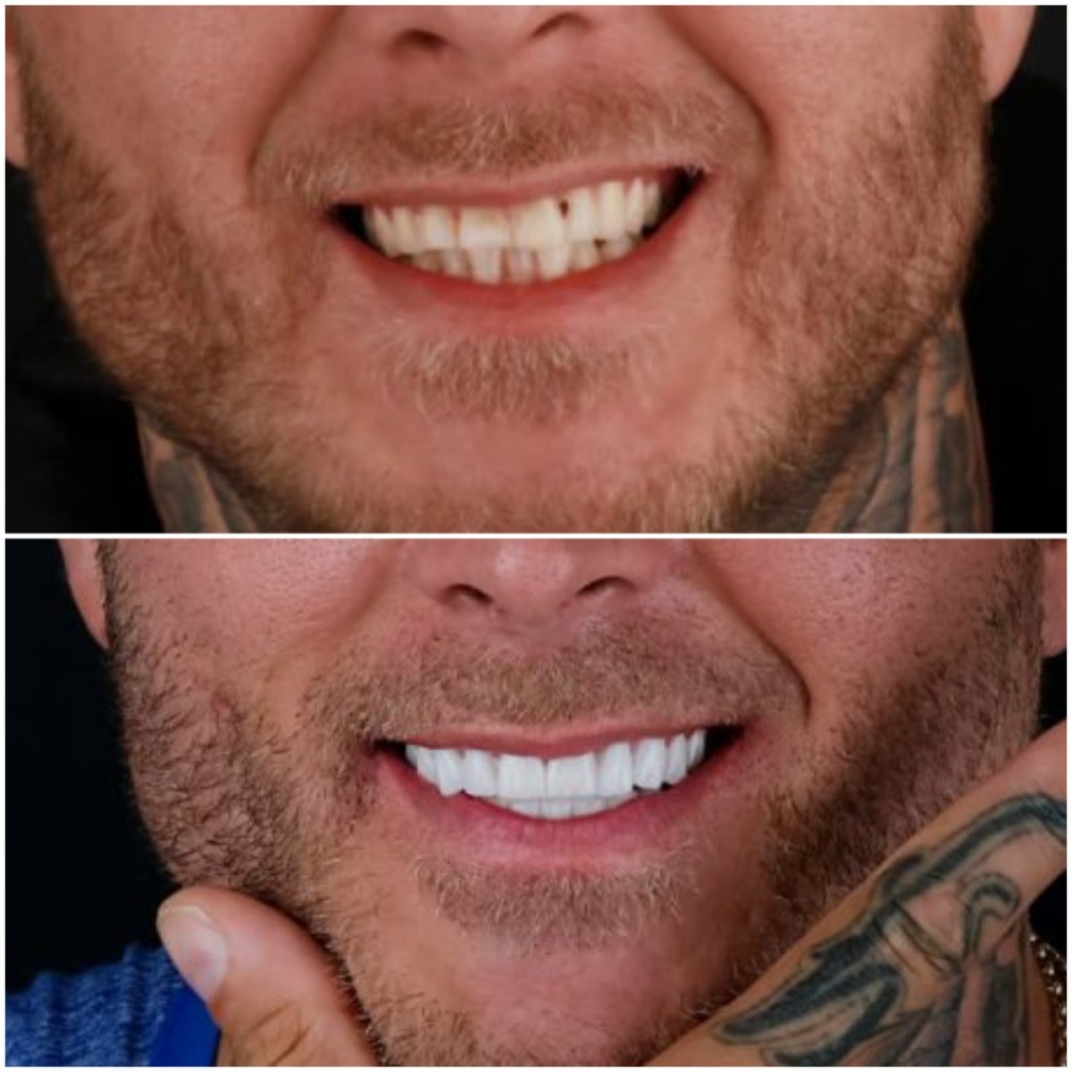Before and after zirconia crown installation at Esvita Clinic – smile makeover results
