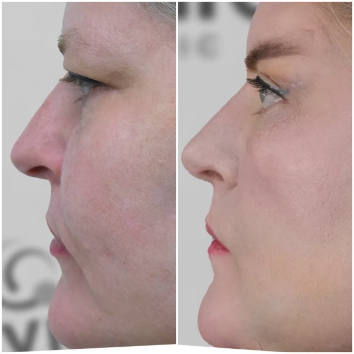 Before and after facelift results at Esvita Clinic – visible facial rejuvenation and contouring