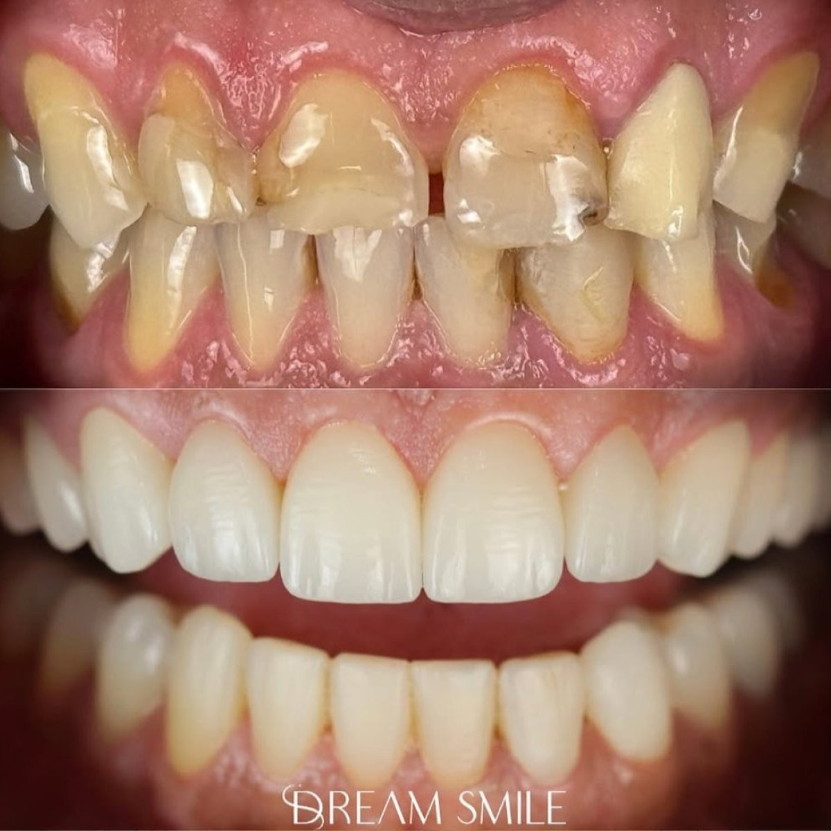 До та після встановлення вініров у Dream Smile – помітна трансформація посмішки та білі зуби
