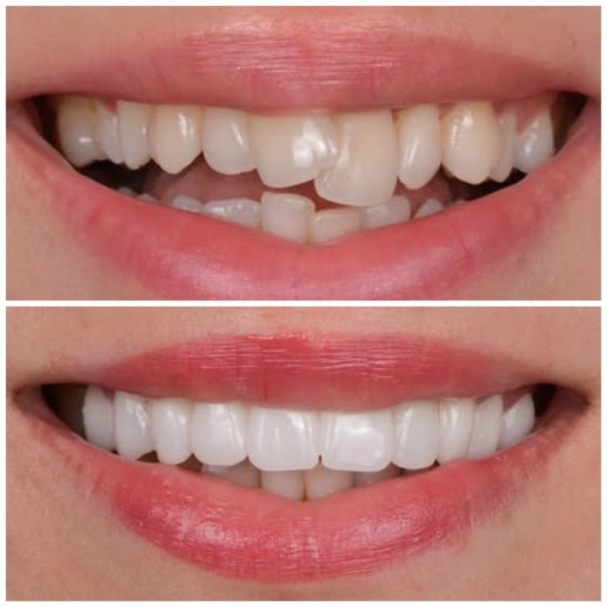 Before and after zirconia crown results at TRAKYADENT DENTAL HEALTH GROUP, smile makeover