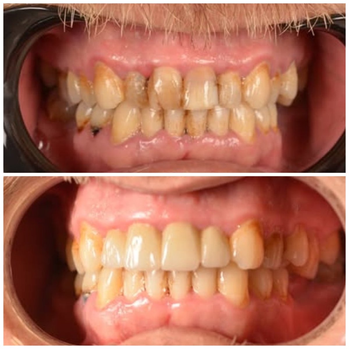 Before and after zirconia crown results at TRAKYADENT DENTAL HEALTH GROUP, improved smile