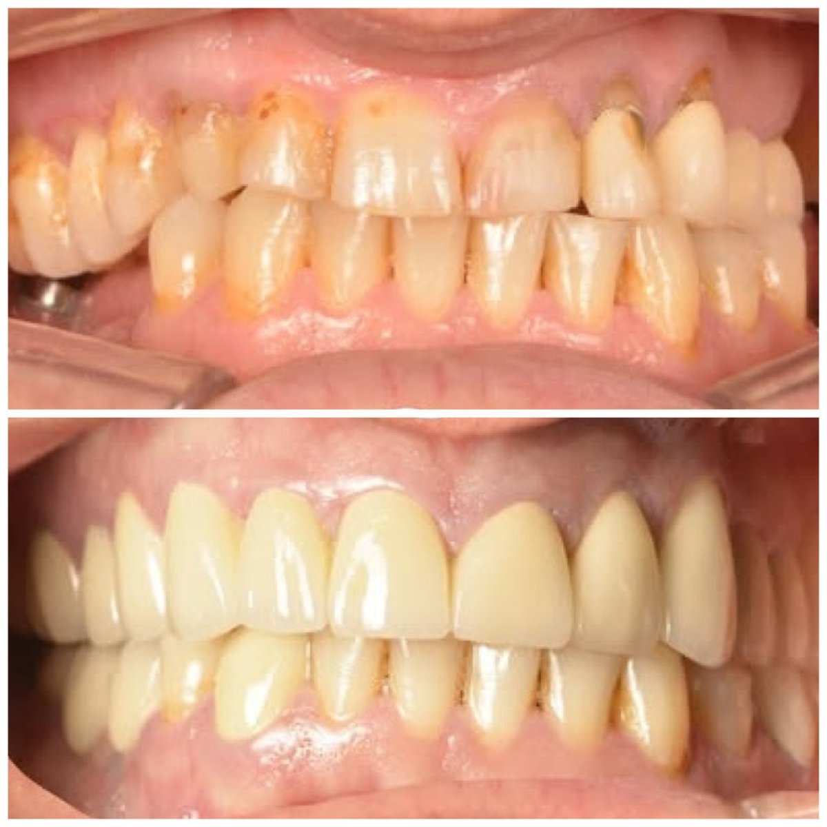 Before and after PFM crown installation at TRAKYADENT DENTAL HEALTH GROUP, smile restoration result