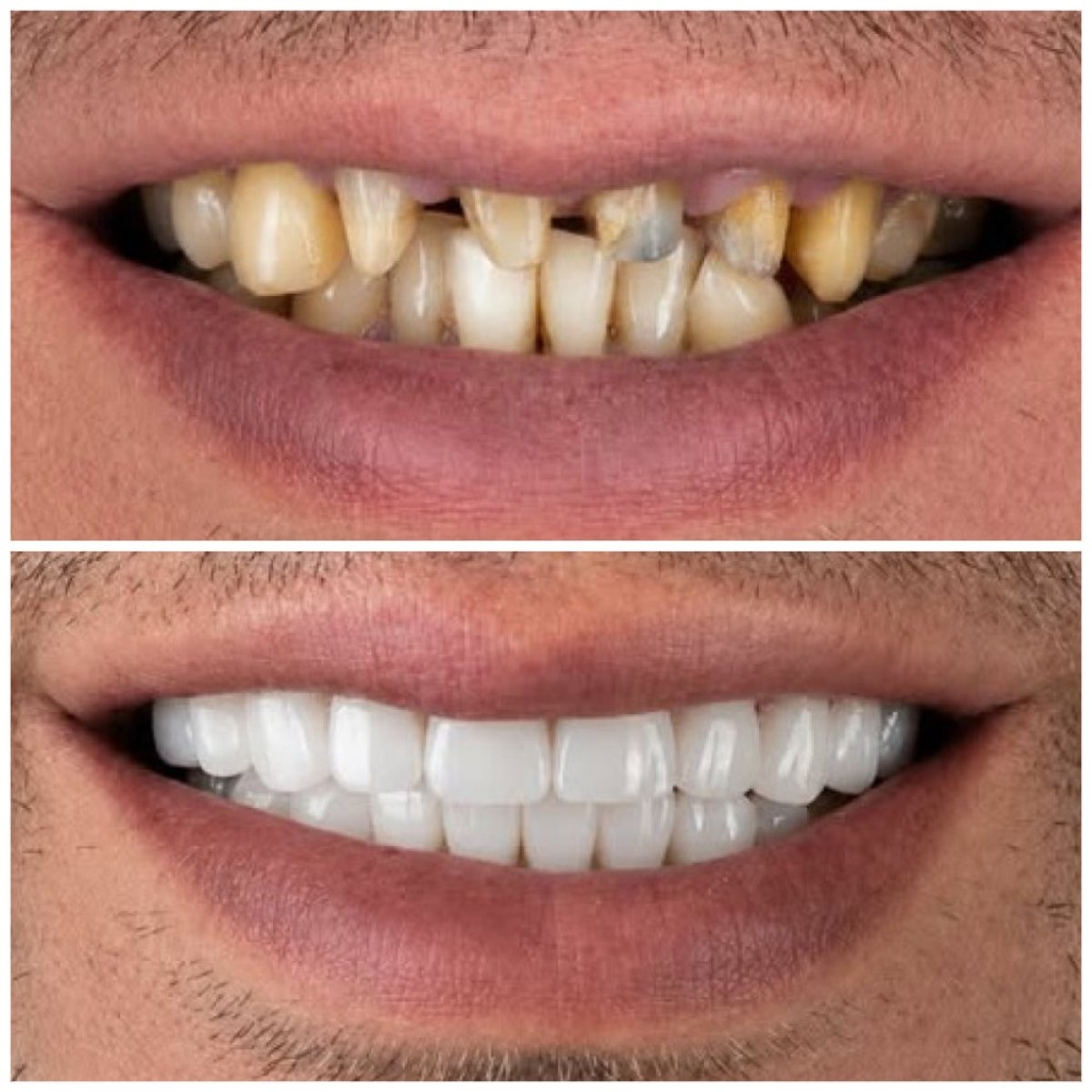 Before and after dental crown installation at TRAKYADENT DENTAL HEALTH GROUP, smile makeover result