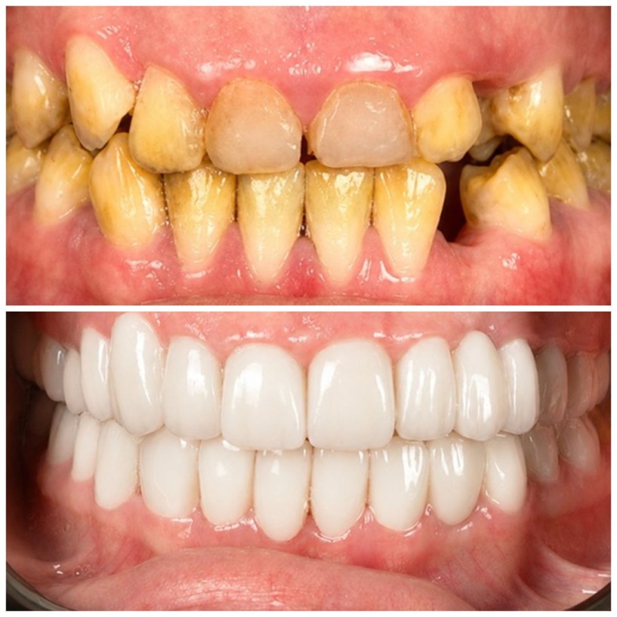 Hollywood Smile before and after results at TRAKYADENT DENTAL HEALTH GROUP, smile makeover