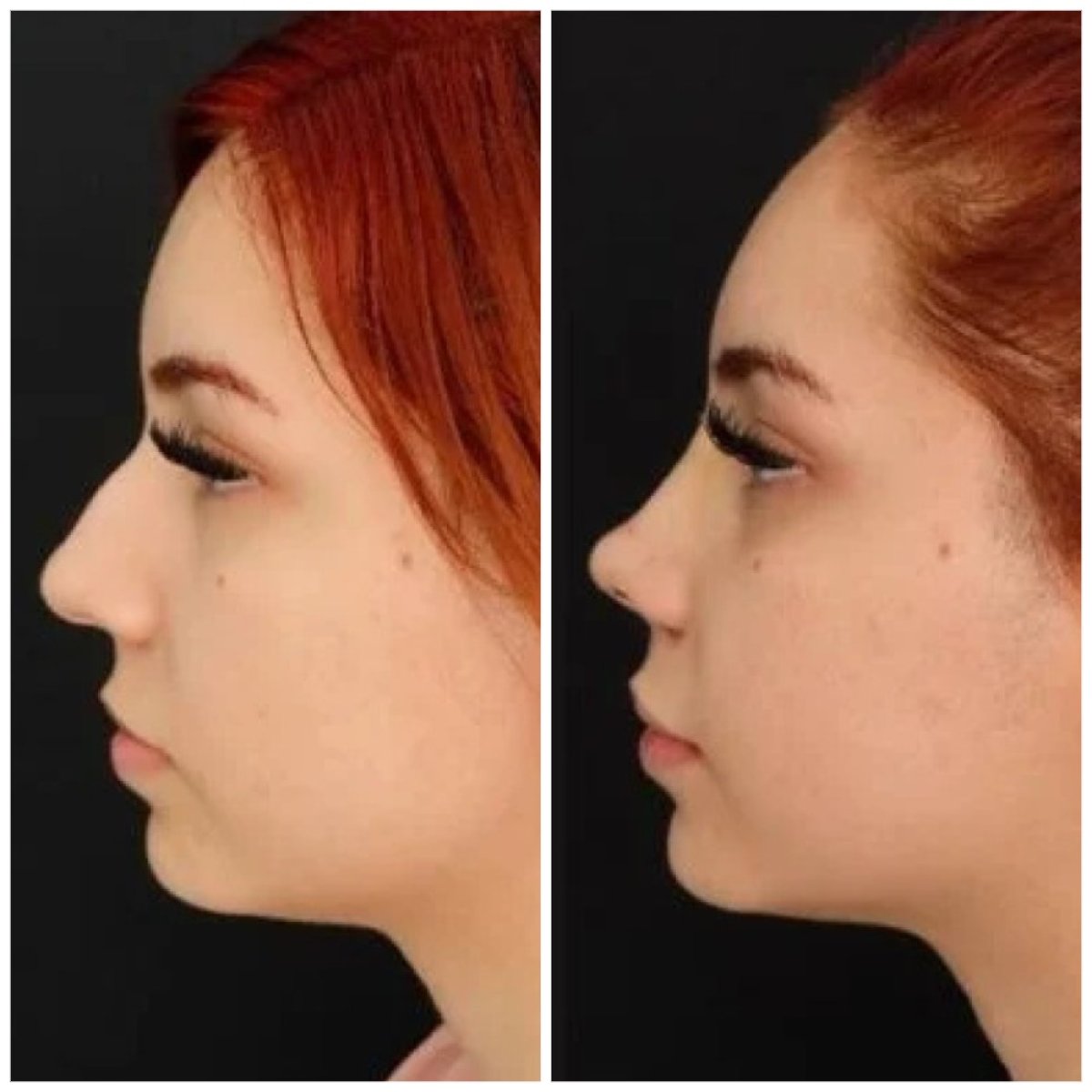 Resultados de rinoplastia antes y después en Egepol Hospitals, perfil nasal mejorado