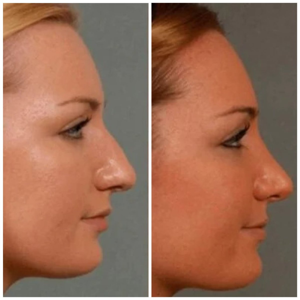 Before and after rhinoplasty results at Egepol Hospitals, improved nose shape and profile