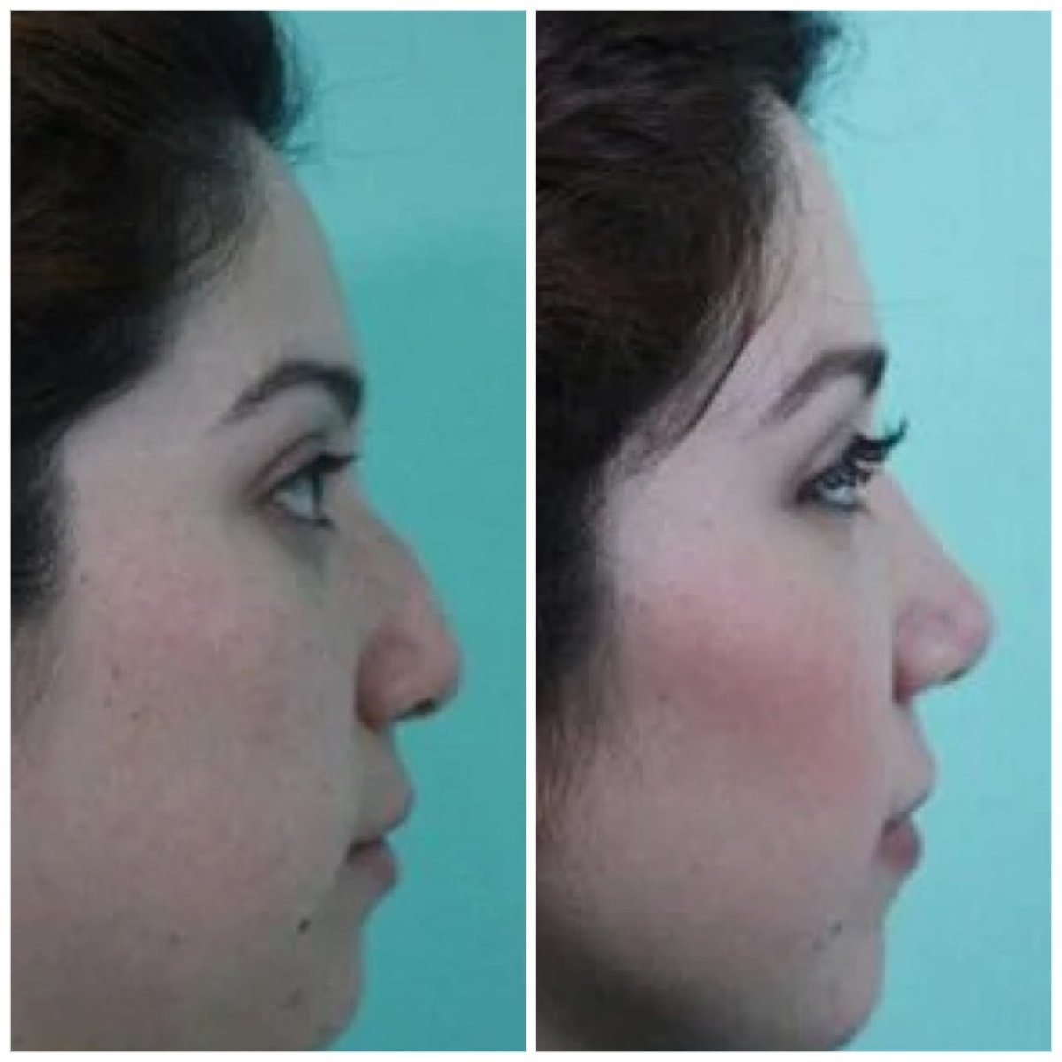نتائج عملية تجميل الأنف قبل وبعد في مستشفى إيجبول، تحسين شكل الأنف والملف الجانبي