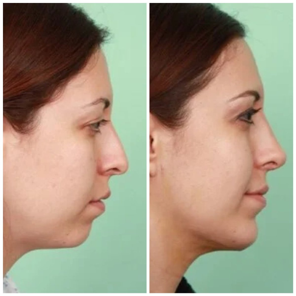 Resultados de rinoplastia antes y después en Egepol Hospitals, mejora de forma y perfil nasal