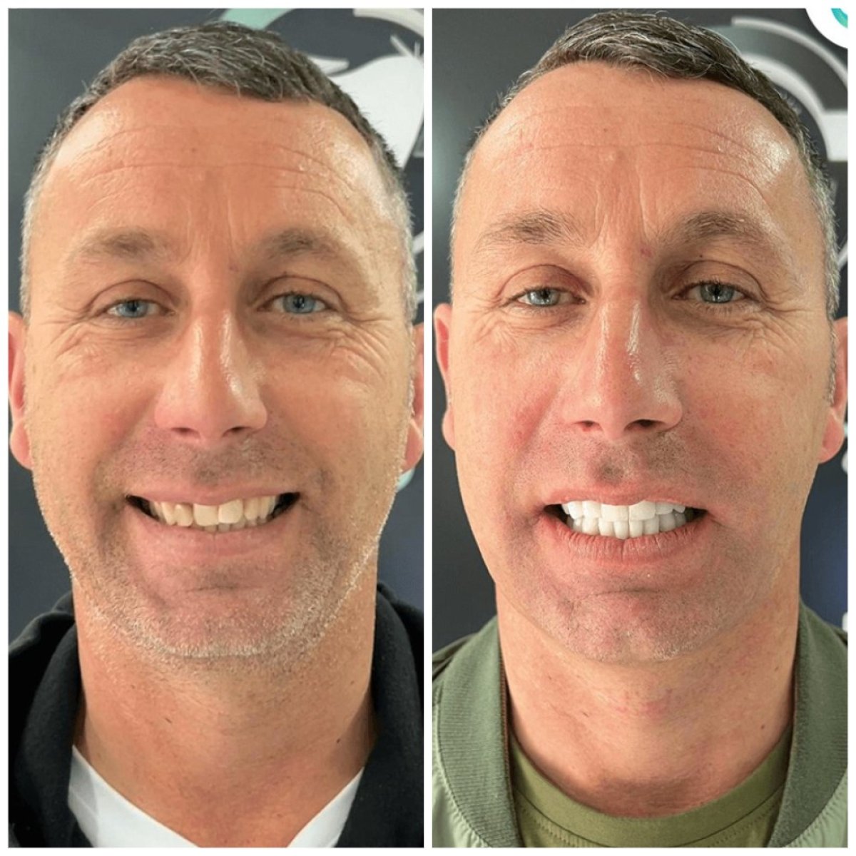 Before and after veneers at Hermes Clinics, smile makeover with whiter, even teeth result
