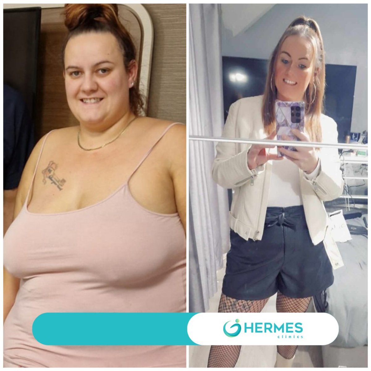 Antes y después de manga gástrica en Hermes Clinics – resultado visible de pérdida de peso