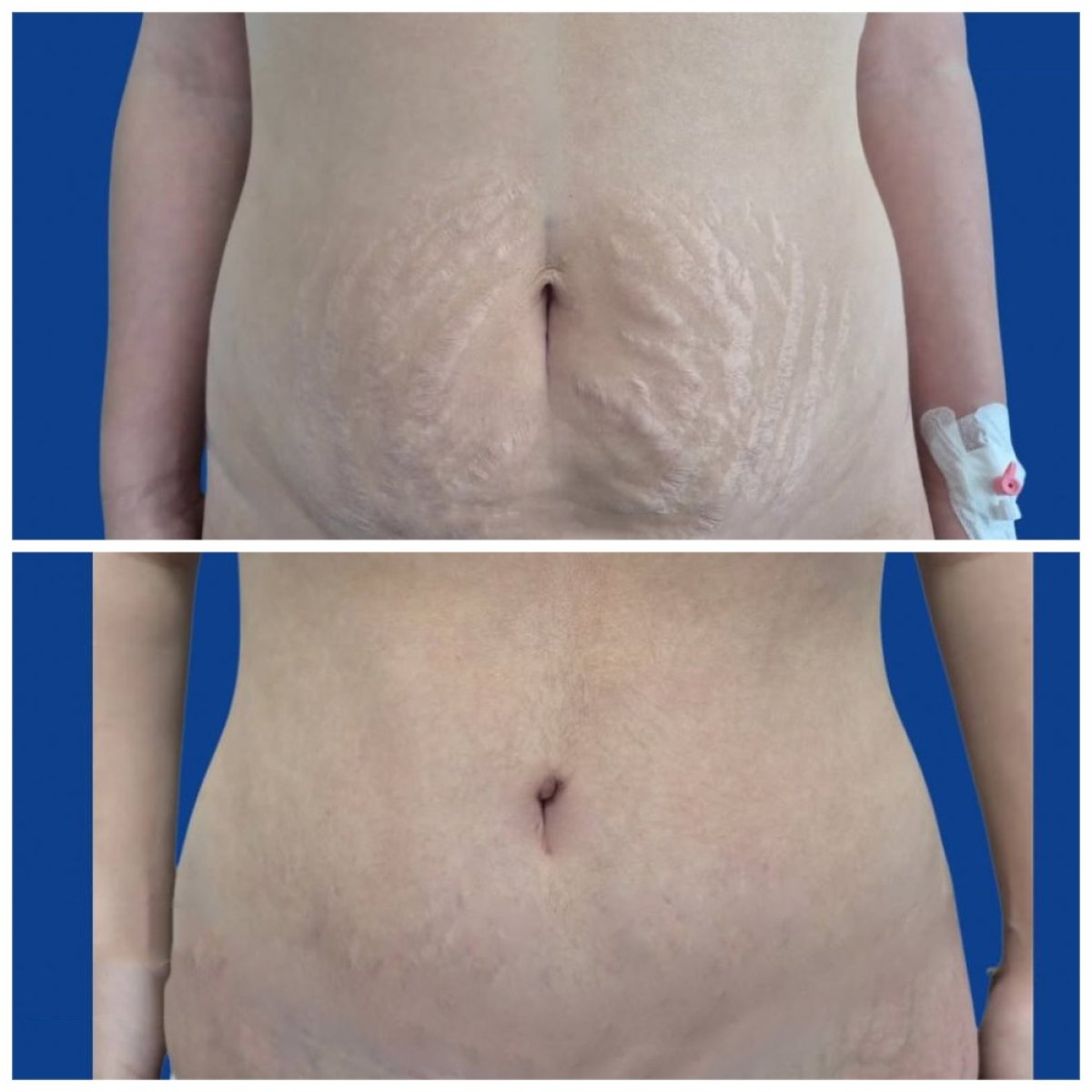 Before and after tummy tuck results at MEDI HORIZON CLINIC ORTHOPEDICS WARSAW POLAND
