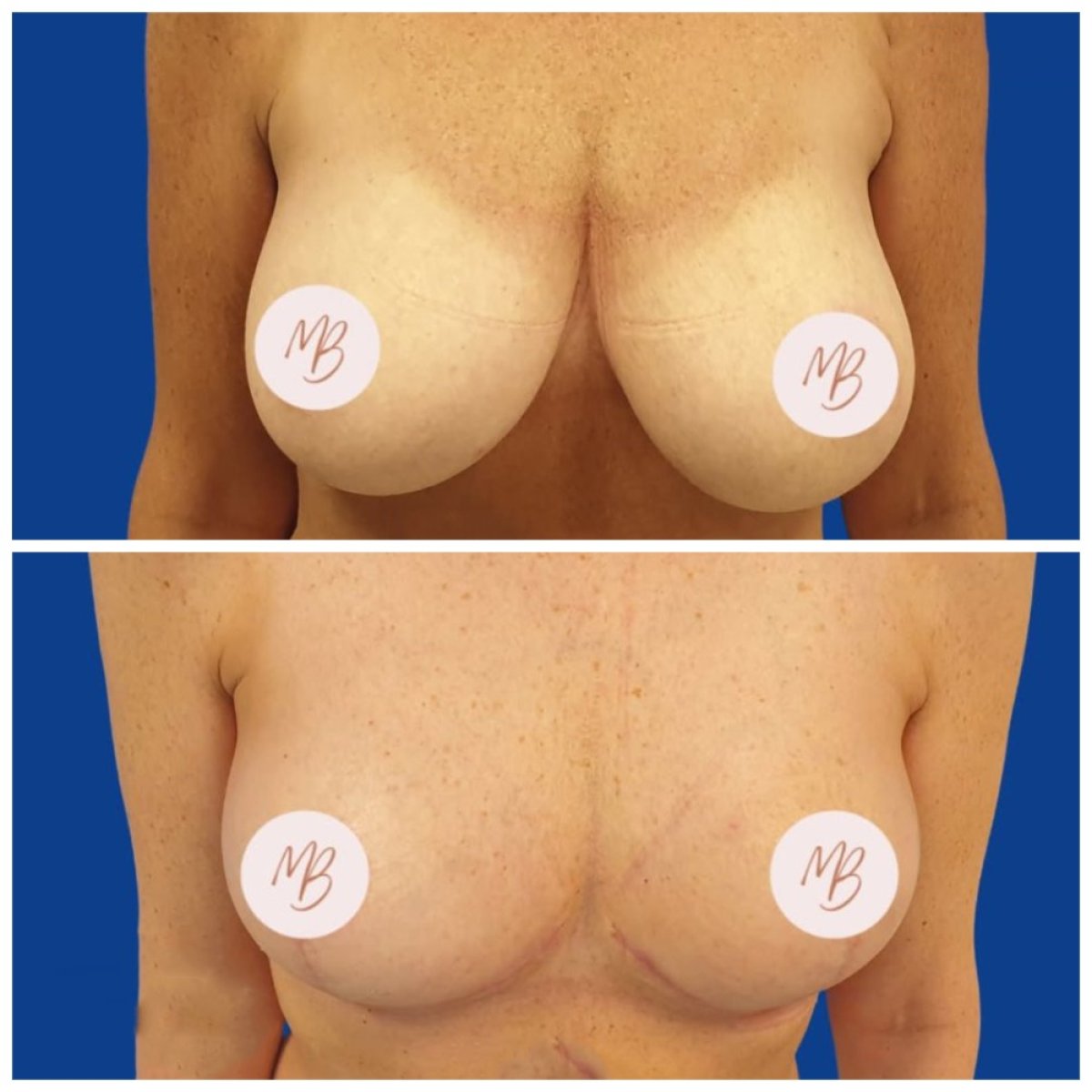 Before and after breast reduction results at MEDI HORIZON CLINIC ORTHOPEDICS WARSAW POLAND