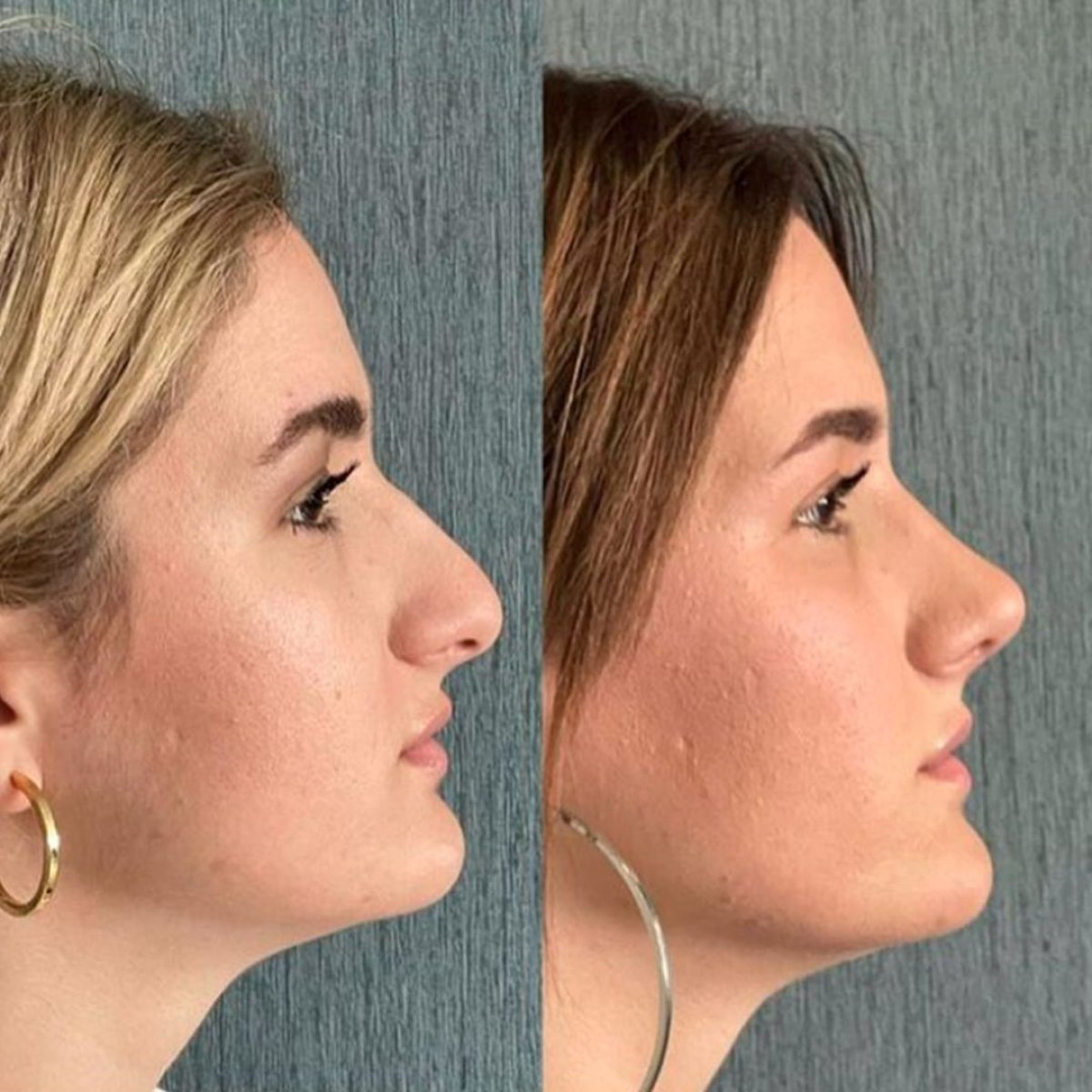 Before and after revision rhinoplasty results at Lokman Hekim Istanbul Hospital, nose reshaping