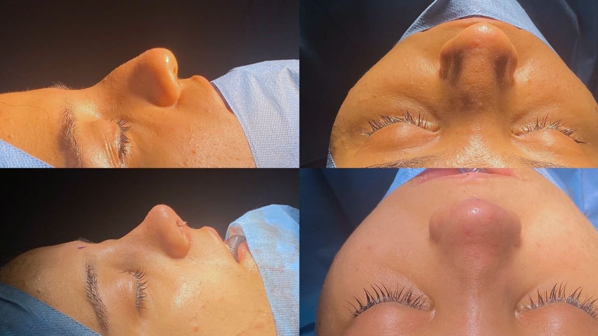 Before and after revision rhinoplasty results at Lokman Hekim Istanbul Hospital, nose reshaping