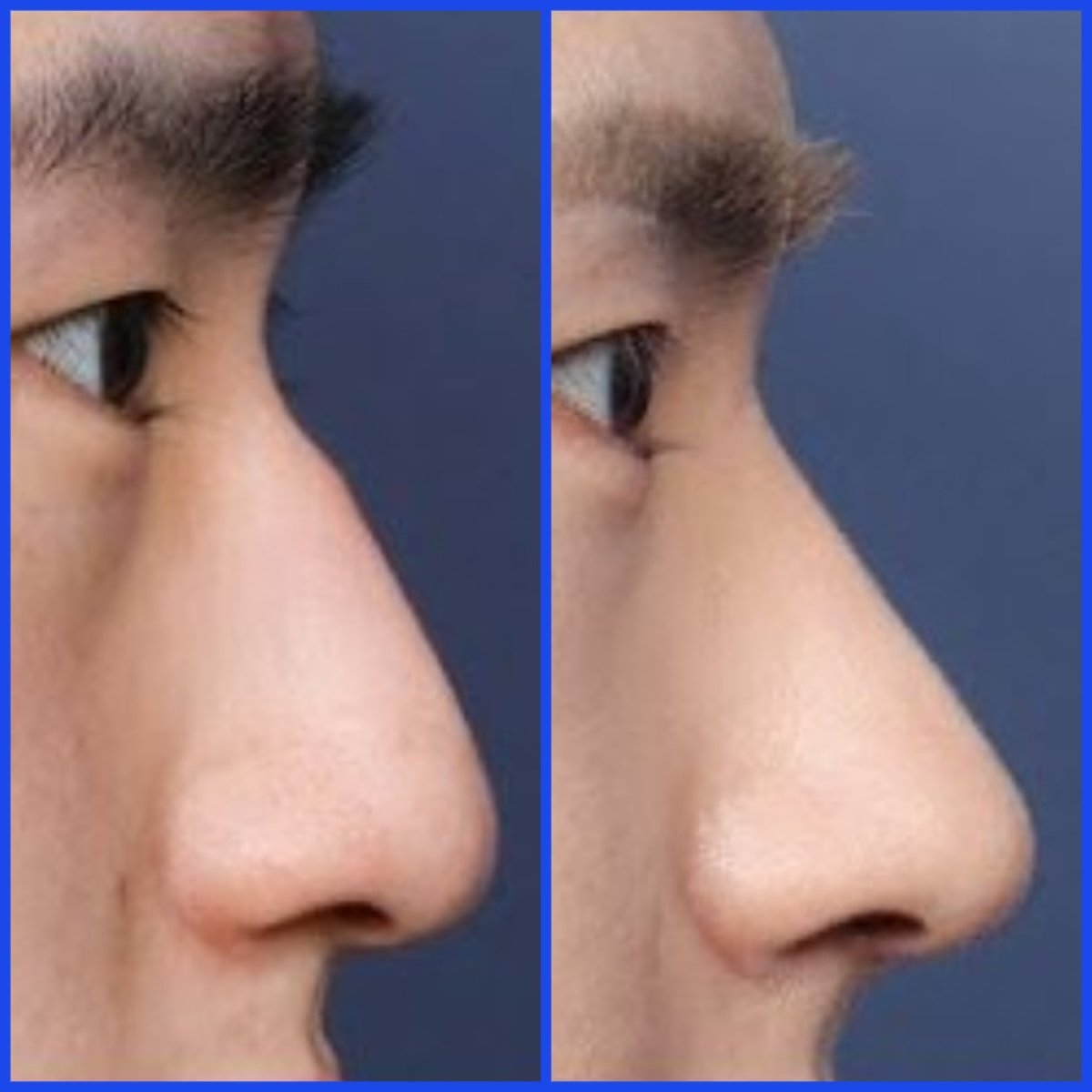 Efekty przed i po rhinoplastyce w WillBe Plastic Surgery Clinic, poprawiony profil nosa