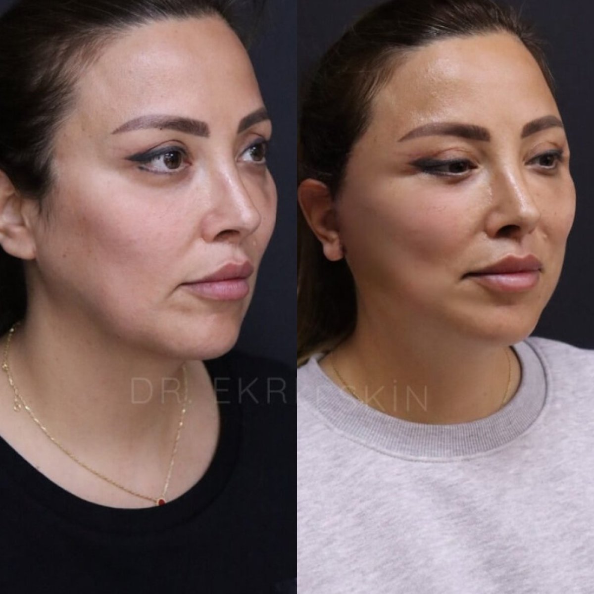 Facelift before and after results at Ekrem Keskin – visible facial contour improvement